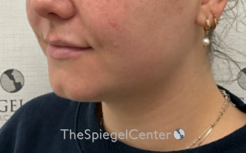 Chin Filler Before & After Gallery - Patient 535729 - Image 3