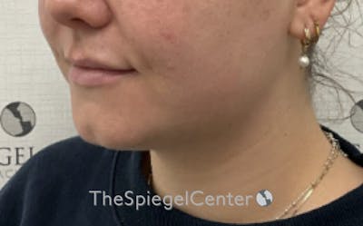Chin Filler Before & After Gallery - Patient 535729 - Image 3