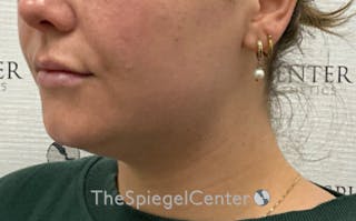 Chin Filler Before & After Gallery - Patient 535729 - Image 4