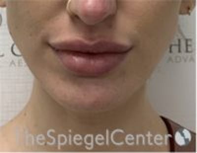 Chin Filler Before & After Gallery - Patient 230081 - Image 1