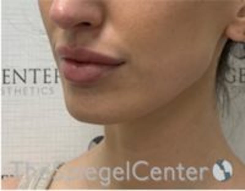 Chin Filler Before & After Gallery - Patient 230081 - Image 3