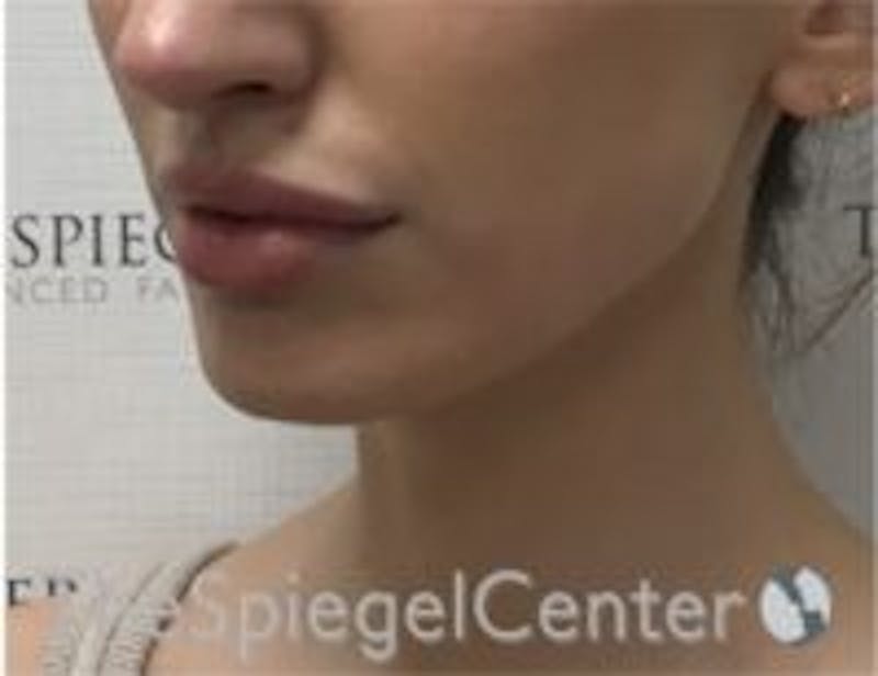 Chin Filler Before & After Gallery - Patient 230081 - Image 4