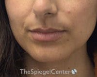 Chin Filler Before & After Gallery - Patient 825863 - Image 1