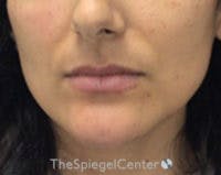 Chin Filler Before & After Gallery - Patient 825863 - Image 2