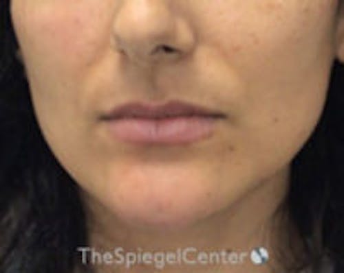 Chin Filler Before & After Gallery - Patient 825863 - Image 2
