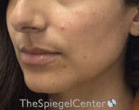 Chin Filler Before & After Gallery - Patient 825863 - Image 3