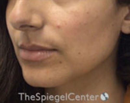 Chin Filler Before & After Gallery - Patient 825863 - Image 3