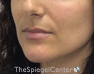 Chin Filler Before & After Gallery - Patient 825863 - Image 4