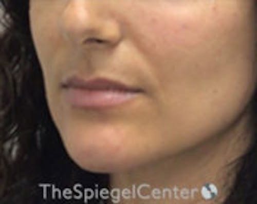 Chin Filler Before & After Gallery - Patient 825863 - Image 4