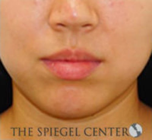 Chin Filler Before & After Gallery - Patient 103523 - Image 1
