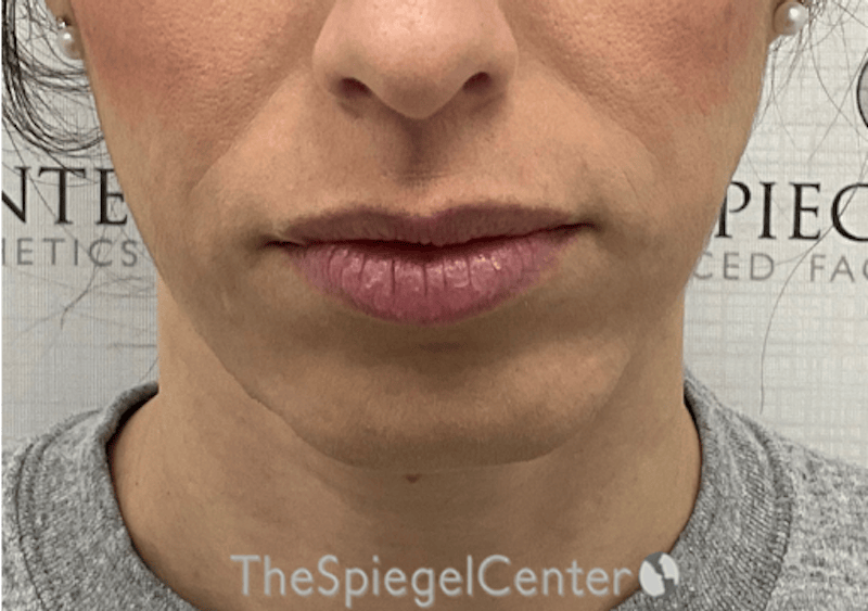 Chin Filler Before & After Gallery - Patient 310578 - Image 1