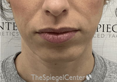 Chin Filler Before & After Gallery - Patient 310578 - Image 1