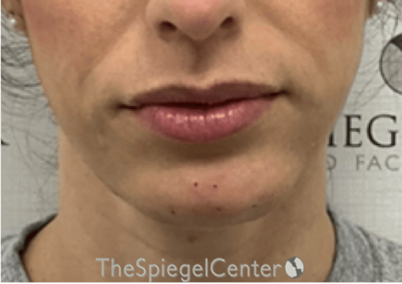 Chin Filler Before & After Gallery - Patient 310578 - Image 2