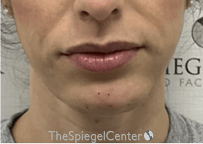 Chin Filler Before & After Gallery - Patient 310578 - Image 2