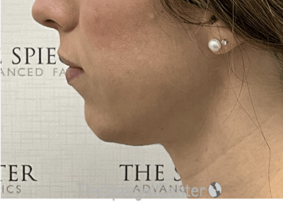 Chin Filler Before & After Gallery - Patient 310578 - Image 3