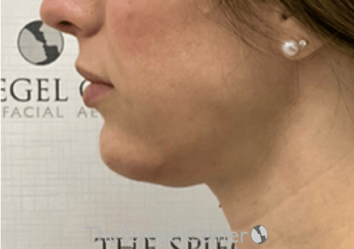Chin Filler Before & After Gallery - Patient 310578 - Image 4