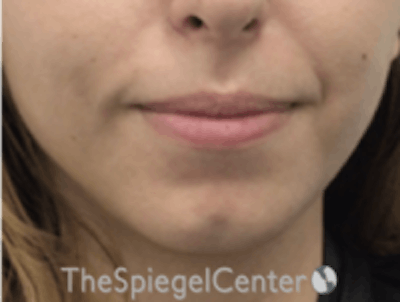 Chin Filler Before & After Gallery - Patient 178637 - Image 1