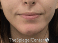 Chin Filler Before & After Gallery - Patient 178637 - Image 2