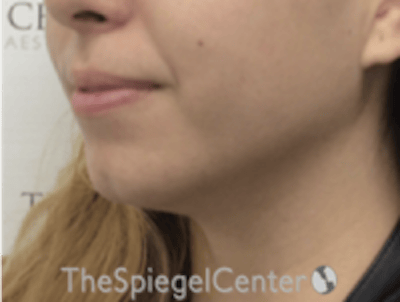 Chin Filler Before & After Gallery - Patient 178637 - Image 3