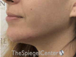 Chin Filler Before & After Gallery - Patient 178637 - Image 4