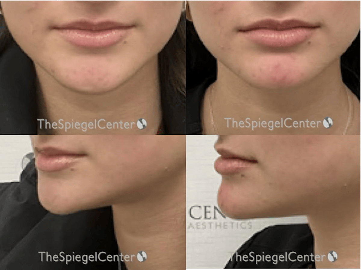 Chin Filler Before & After Gallery - Patient 137304 - Image 1