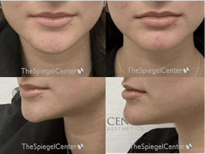 Chin Filler Before & After Gallery - Patient 137304 - Image 1