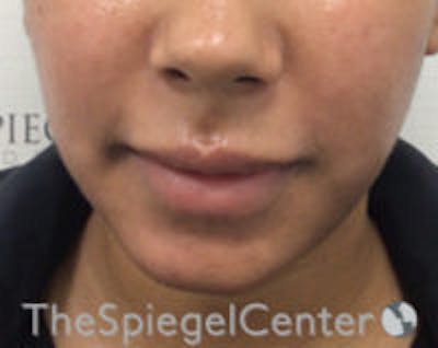 Chin Filler Before & After Gallery - Patient 426258 - Image 1