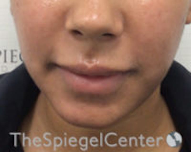 Chin Filler Before & After Gallery - Patient 426258 - Image 1