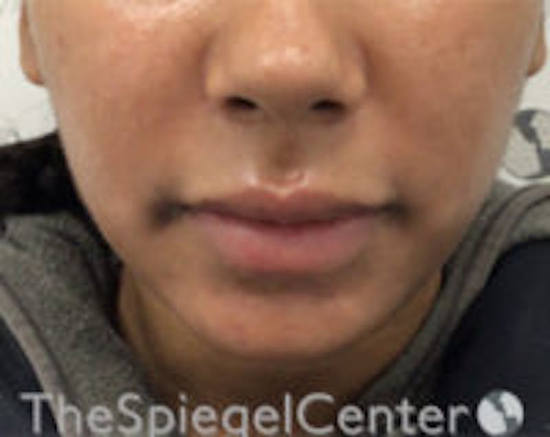 Chin Filler Before & After Gallery - Patient 426258 - Image 2