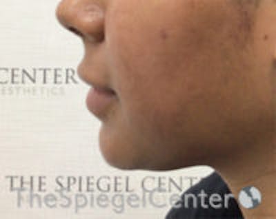 Chin Filler Before & After Gallery - Patient 426258 - Image 3
