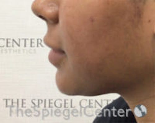 Chin Filler Before & After Gallery - Patient 426258 - Image 3