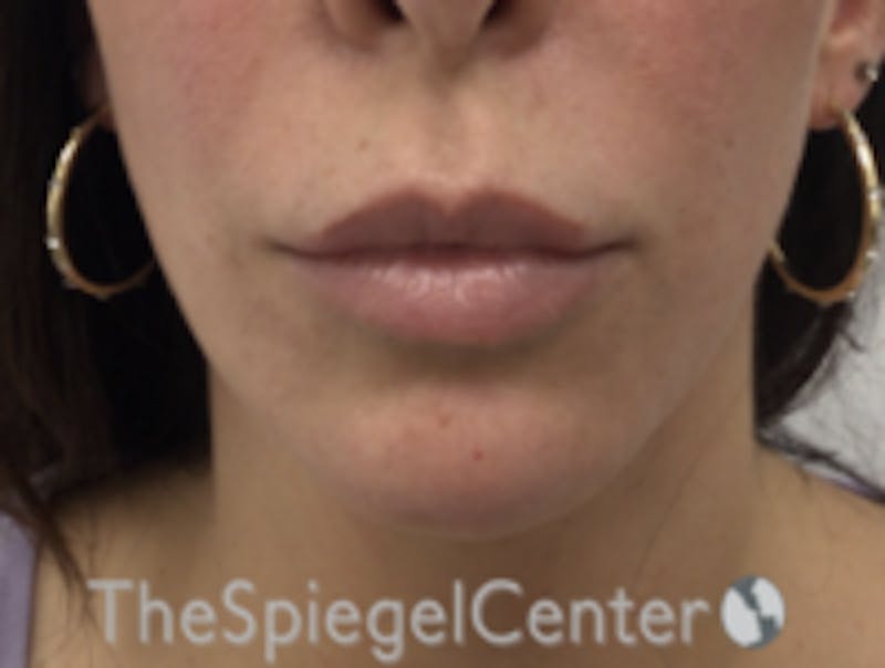 Chin Filler Before & After Gallery - Patient 263844 - Image 2