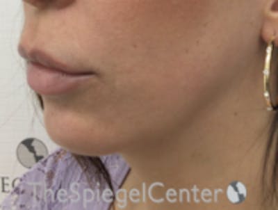 Chin Filler Before & After Gallery - Patient 263844 - Image 3
