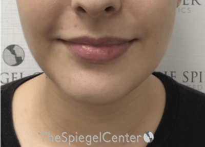 Chin Filler Before & After Gallery - Patient 308366 - Image 1