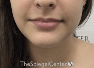 Chin Filler Before & After Gallery - Patient 308366 - Image 2