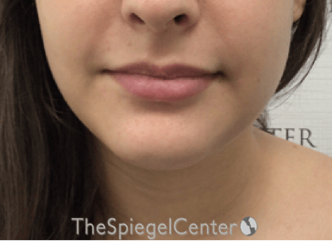 Chin Filler Before & After Gallery - Patient 308366 - Image 2