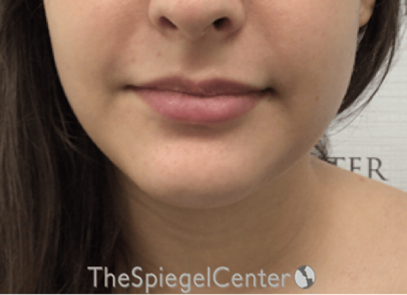 Chin Filler Before & After Gallery - Patient 308366 - Image 2