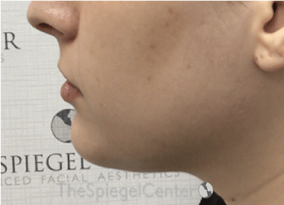 Chin Filler Before & After Gallery - Patient 308366 - Image 3