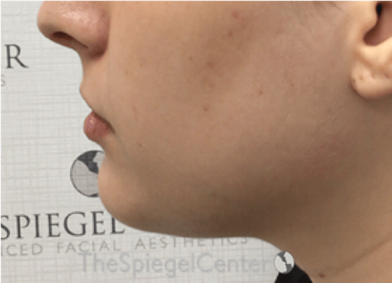 Chin Filler Before & After Gallery - Patient 308366 - Image 3
