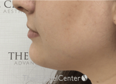 Chin Filler Before & After Gallery - Patient 308366 - Image 4