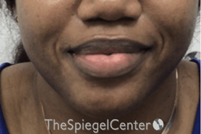 Chin Filler Before & After Gallery - Patient 360685 - Image 1