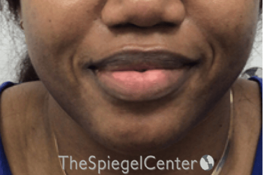 Chin Filler Before & After Gallery - Patient 360685 - Image 1