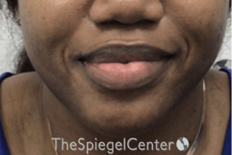 Chin Filler Before & After Gallery - Patient 360685 - Image 1