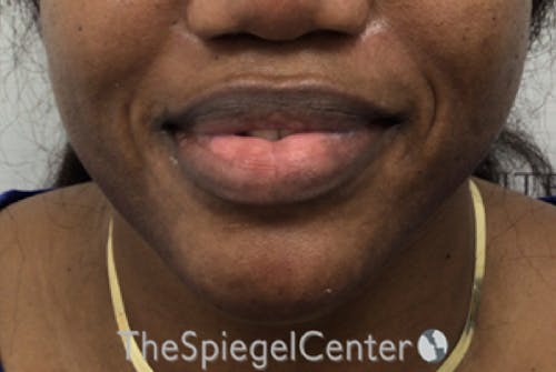 Chin Filler Before & After Gallery - Patient 360685 - Image 2