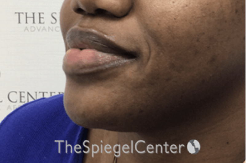 Chin Filler Before & After Gallery - Patient 360685 - Image 3