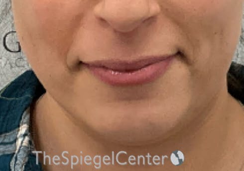 Chin Filler Before & After Gallery - Patient 941454 - Image 1