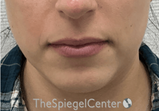 Chin Filler Before & After Gallery - Patient 941454 - Image 2
