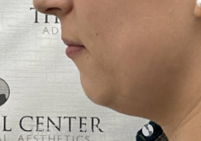 Chin Filler Before & After Gallery - Patient 941454 - Image 3