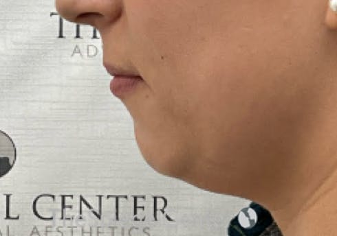Chin Filler Before & After Gallery - Patient 941454 - Image 3