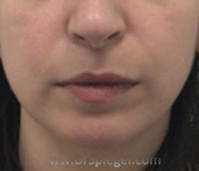 Chin Filler Before & After Gallery - Patient 149700 - Image 2